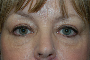 Blepharoplasty 3b